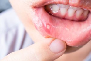 4 Simple Tips To Cure A Mouth Sore