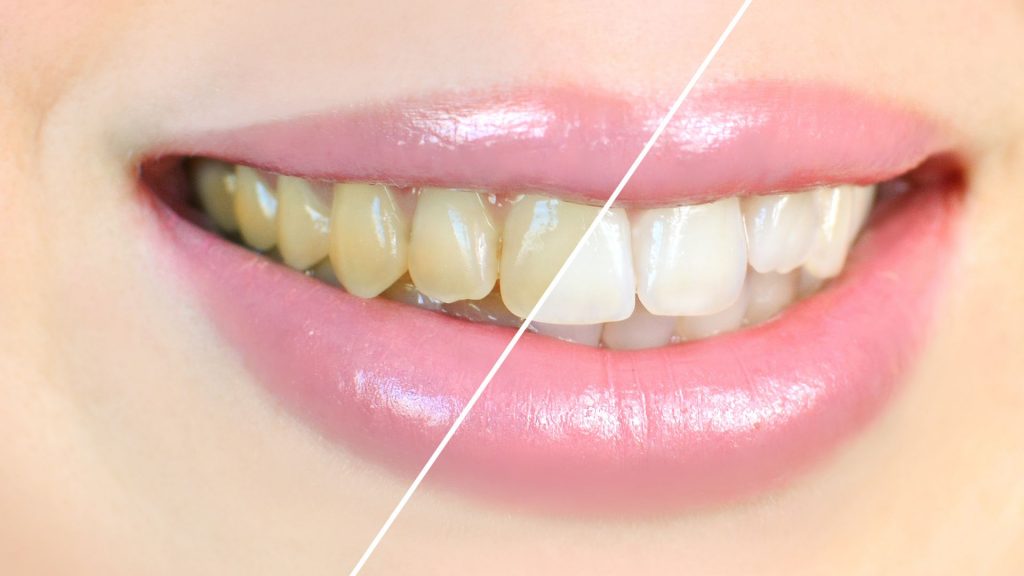 Before And After Teeth After Tartar Removal At Home
