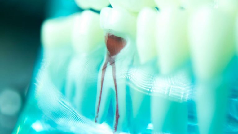 Root Canal Procedure: How Long Does it Take?