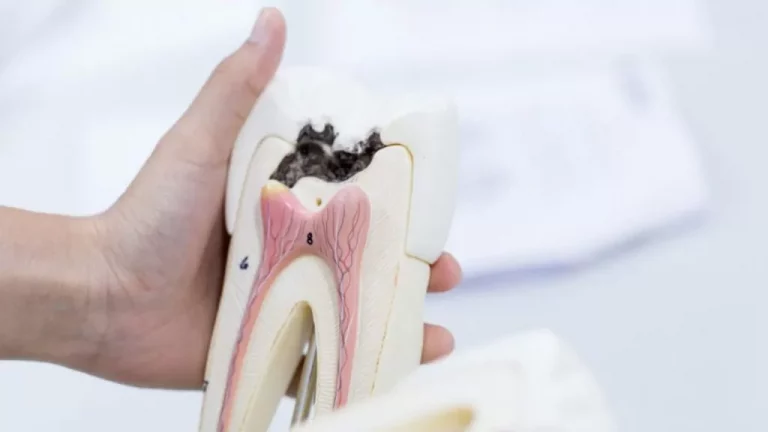 A Hand Holding a Tooth Cavity Model